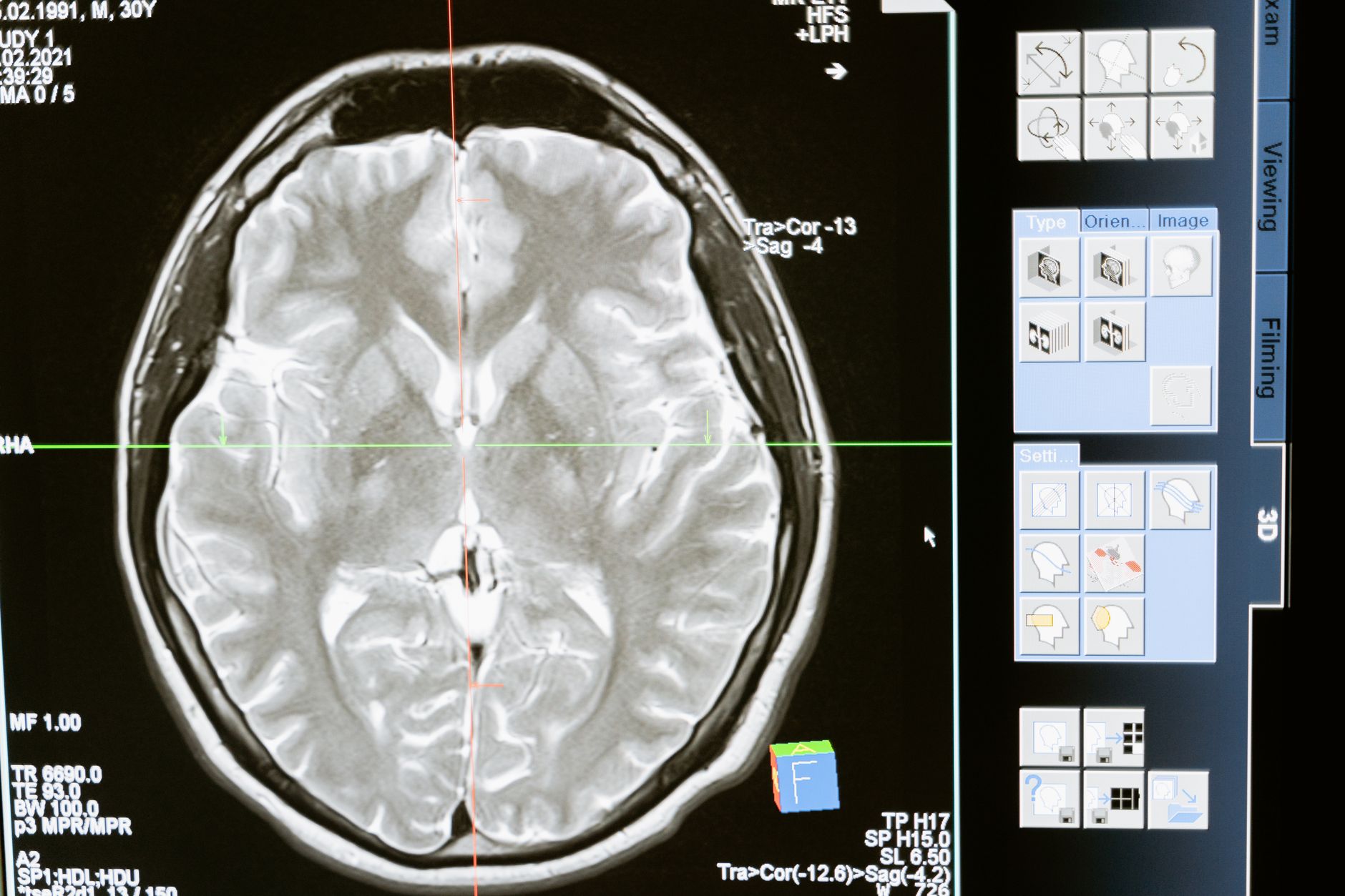 Imagem ilustrativa: Imagem de ressonância magnética do cérebro exibida na tela de uma estação de trabalho médica